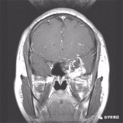 【病例】鞍旁成熟性囊性畸胎瘤1例MR 【病例】鞍旁成熟性囊性畸胎瘤1例MR