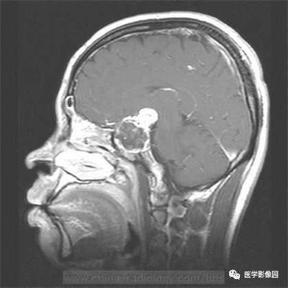 【病例】鞍旁成熟性囊性畸胎瘤1例MR 【病例】鞍旁成熟性囊性畸胎瘤1例MR