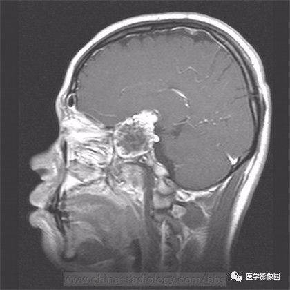 【病例】鞍旁成熟性囊性畸胎瘤1例MR 【病例】鞍旁成熟性囊性畸胎瘤1例MR