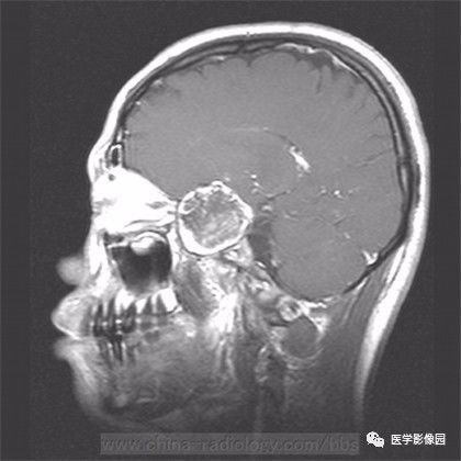 【病例】鞍旁成熟性囊性畸胎瘤1例MR 【病例】鞍旁成熟性囊性畸胎瘤1例MR