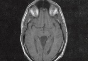 【病例】四叠体池表皮样囊肿1例MR 【病例】四叠体池表皮样囊肿1例MR
