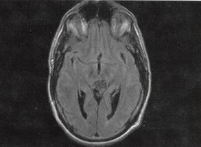 【病例】四叠体池表皮样囊肿1例MR 【病例】四叠体池表皮样囊肿1例MR