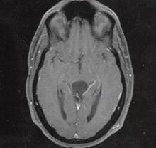 【病例】四叠体池表皮样囊肿1例MR 【病例】四叠体池表皮样囊肿1例MR