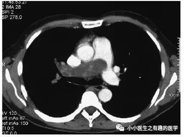 肺动脉充盈缺损不一定是血栓—学习被老外误诊误治的肺栓塞 肺动脉充盈缺损不一定是血栓—学习被老外误诊误治的肺栓塞