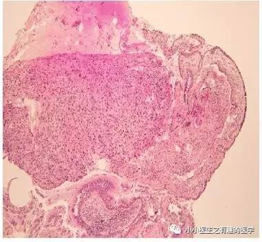 肺动脉充盈缺损不一定是血栓—学习被老外误诊误治的肺栓塞 肺动脉充盈缺损不一定是血栓—学习被老外误诊误治的肺栓塞