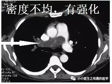 肺动脉充盈缺损不一定是血栓—学习被老外误诊误治的肺栓塞 肺动脉充盈缺损不一定是血栓—学习被老外误诊误治的肺栓塞