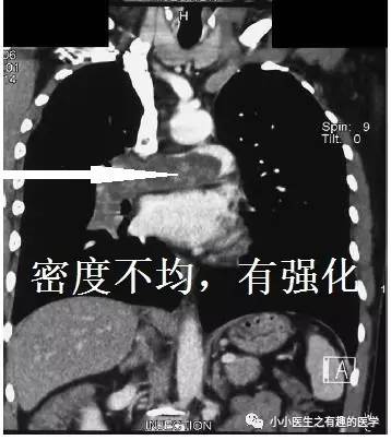 肺动脉充盈缺损不一定是血栓—学习被老外误诊误治的肺栓塞 肺动脉充盈缺损不一定是血栓—学习被老外误诊误治的肺栓塞