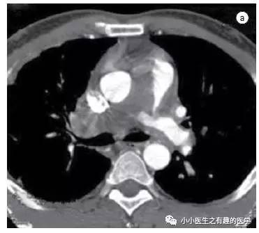 肺动脉充盈缺损不一定是血栓—学习被老外误诊误治的肺栓塞 肺动脉充盈缺损不一定是血栓—学习被老外误诊误治的肺栓塞