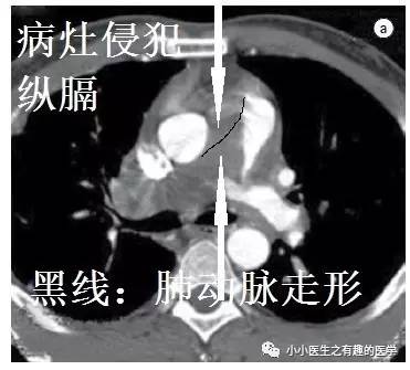 肺动脉充盈缺损不一定是血栓—学习被老外误诊误治的肺栓塞 肺动脉充盈缺损不一定是血栓—学习被老外误诊误治的肺栓塞