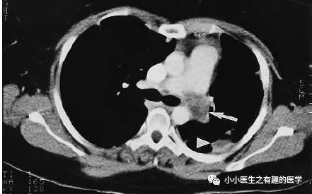 肺动脉充盈缺损不一定是血栓—学习被老外误诊误治的肺栓塞 肺动脉充盈缺损不一定是血栓—学习被老外误诊误治的肺栓塞