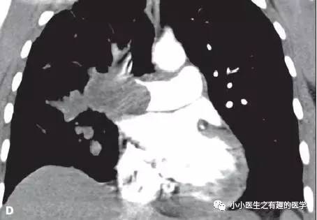 肺动脉充盈缺损不一定是血栓—学习被老外误诊误治的肺栓塞 肺动脉充盈缺损不一定是血栓—学习被老外误诊误治的肺栓塞