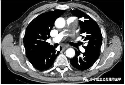 肺动脉充盈缺损不一定是血栓—学习被老外误诊误治的肺栓塞 肺动脉充盈缺损不一定是血栓—学习被老外误诊误治的肺栓塞