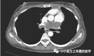 肺动脉充盈缺损不一定是血栓—学习被老外误诊误治的肺栓塞 肺动脉充盈缺损不一定是血栓—学习被老外误诊误治的肺栓塞