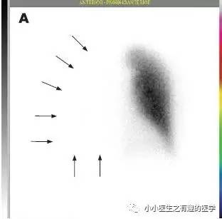 肺动脉充盈缺损不一定是血栓—学习被老外误诊误治的肺栓塞 肺动脉充盈缺损不一定是血栓—学习被老外误诊误治的肺栓塞