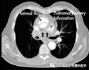 肺动脉充盈缺损不一定是血栓—学习被老外误诊误治的肺栓塞 肺动脉充盈缺损不一定是血栓—学习被老外误诊误治的肺栓塞
