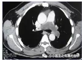 肺动脉充盈缺损不一定是血栓—学习被老外误诊误治的肺栓塞 肺动脉充盈缺损不一定是血栓—学习被老外误诊误治的肺栓塞