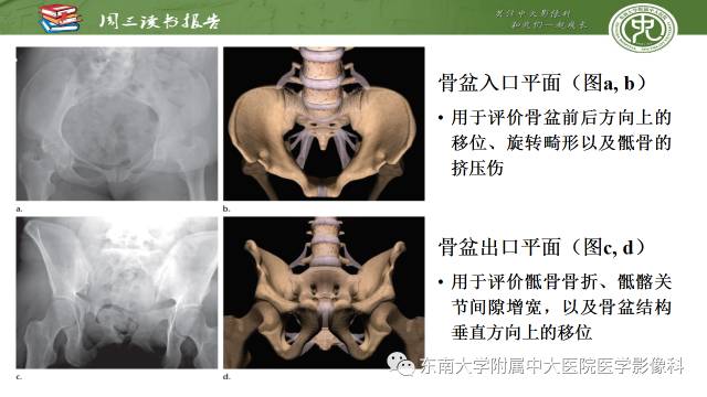 【PPT】骨盆环骨折-骨科医生想获知的内容