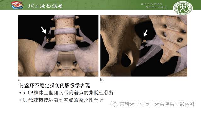 【PPT】骨盆环骨折-骨科医生想获知的内容
