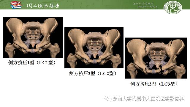 【PPT】骨盆环骨折-骨科医生想获知的内容