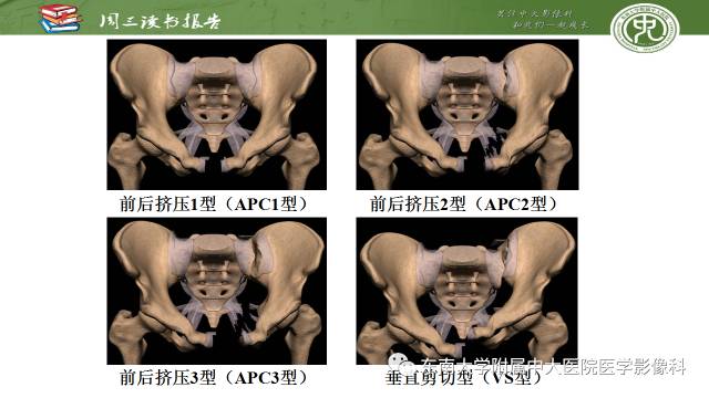 【PPT】骨盆环骨折-骨科医生想获知的内容