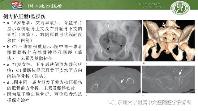 【PPT】骨盆环骨折-骨科医生想获知的内容
