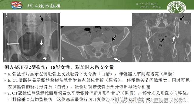 【PPT】骨盆环骨折-骨科医生想获知的内容