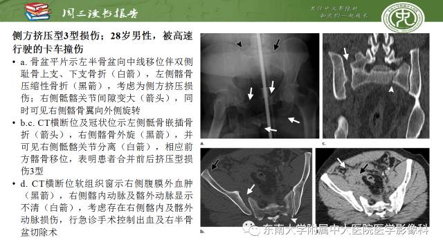 【PPT】骨盆环骨折-骨科医生想获知的内容