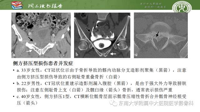 【PPT】骨盆环骨折-骨科医生想获知的内容