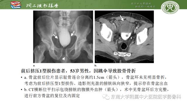 【PPT】骨盆环骨折-骨科医生想获知的内容