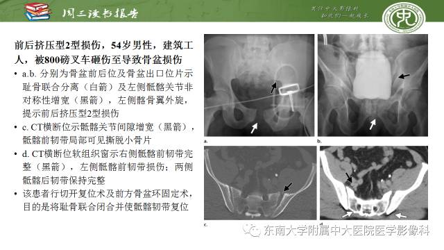 【PPT】骨盆环骨折-骨科医生想获知的内容