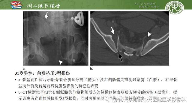 【PPT】骨盆环骨折-骨科医生想获知的内容