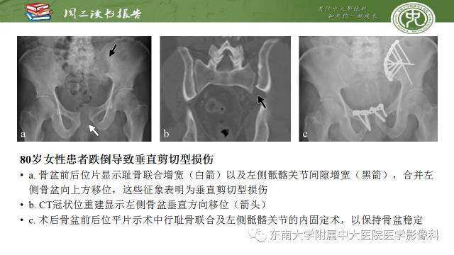 【PPT】骨盆环骨折-骨科医生想获知的内容