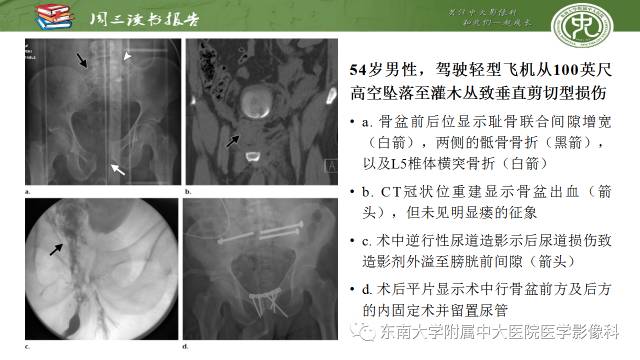 【PPT】骨盆环骨折-骨科医生想获知的内容