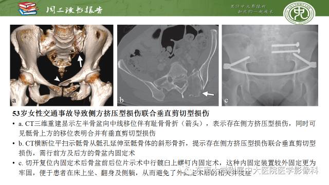 【PPT】骨盆环骨折-骨科医生想获知的内容