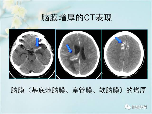 【PPT 】颅内结核专家共识解读