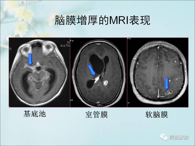 【PPT 】颅内结核专家共识解读