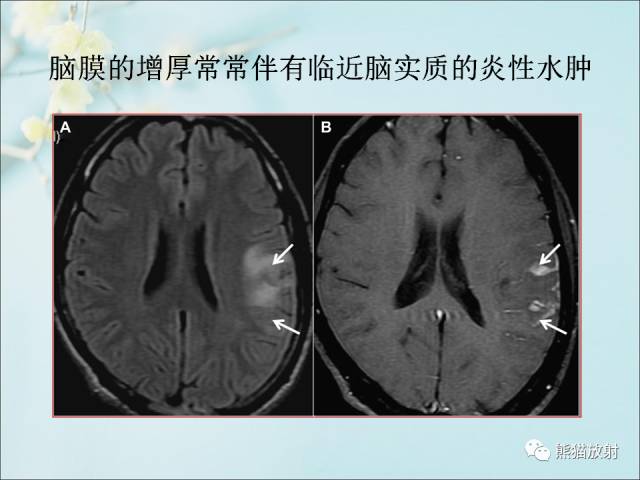 【PPT 】颅内结核专家共识解读