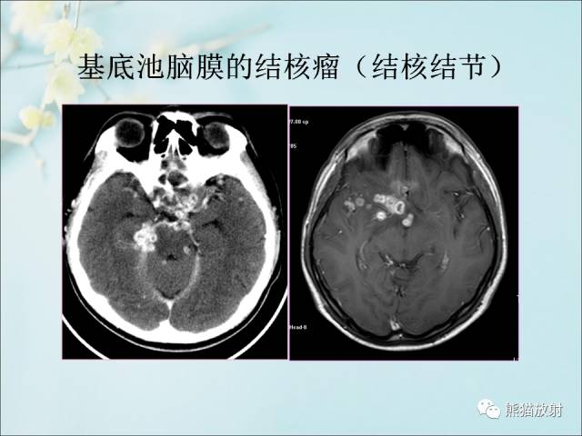 【PPT 】颅内结核专家共识解读