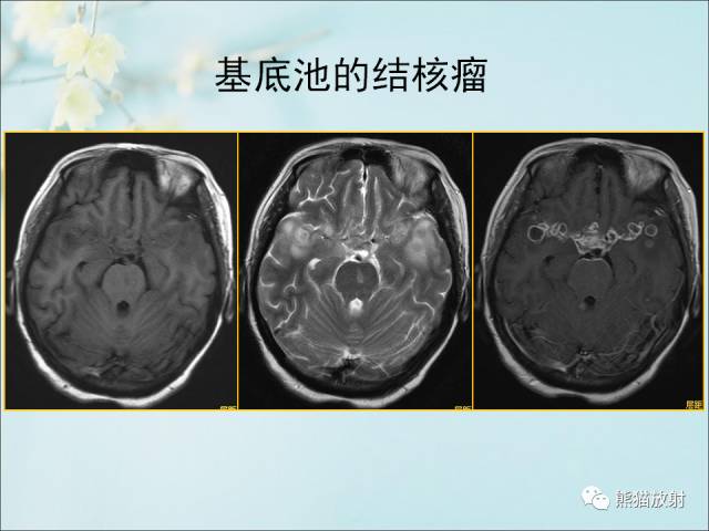 【PPT 】颅内结核专家共识解读