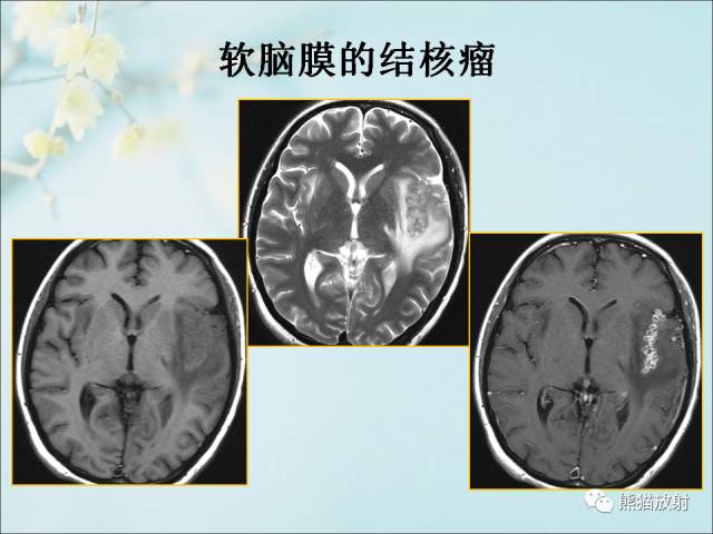 【PPT 】颅内结核专家共识解读