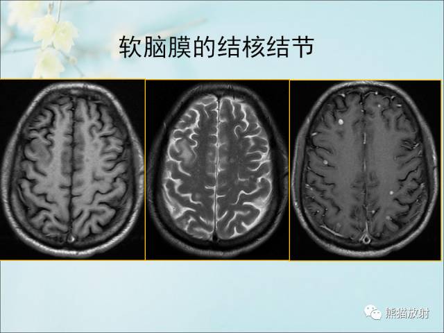 【PPT 】颅内结核专家共识解读