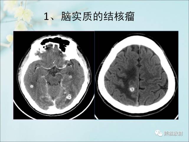 【PPT 】颅内结核专家共识解读