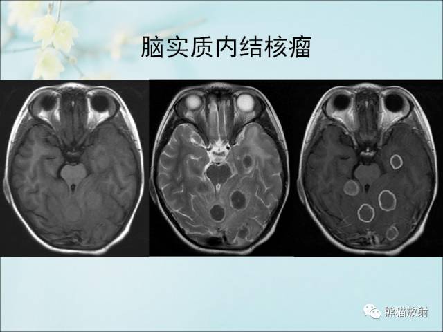 【PPT 】颅内结核专家共识解读