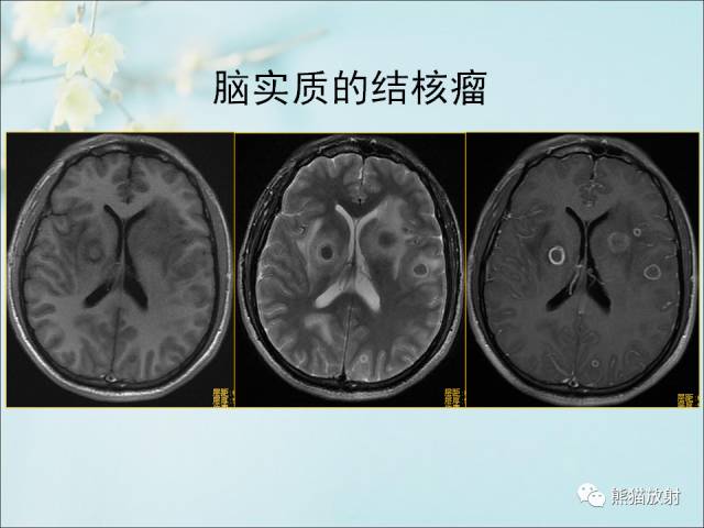 【PPT 】颅内结核专家共识解读