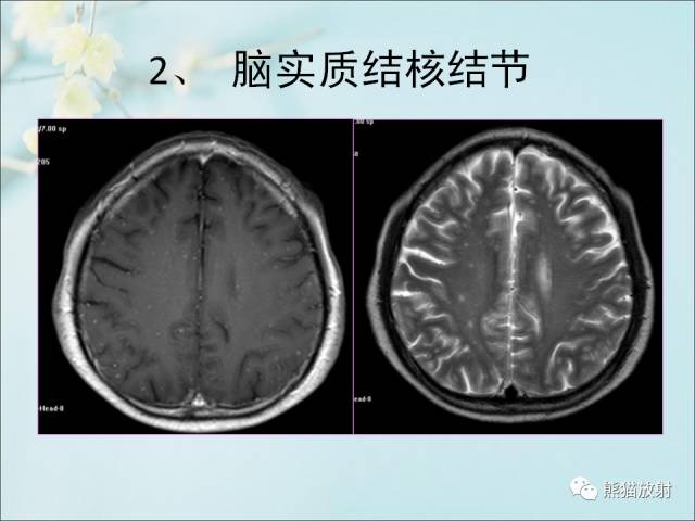【PPT 】颅内结核专家共识解读
