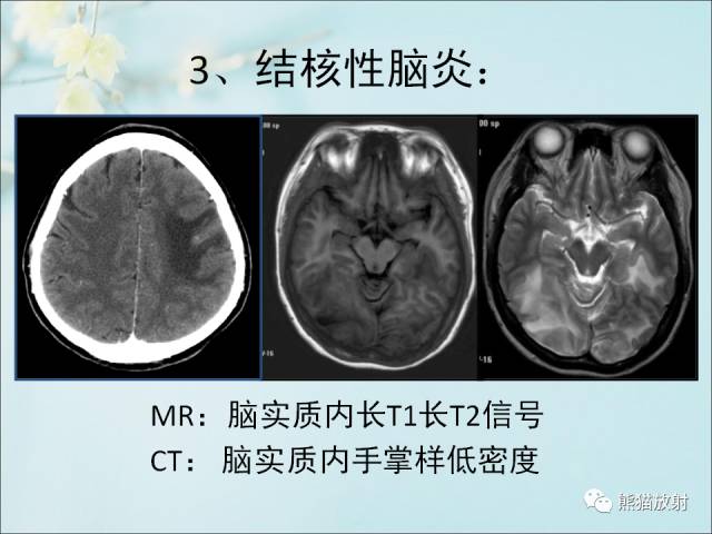 【PPT 】颅内结核专家共识解读