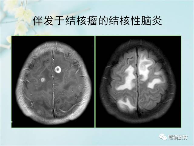 【PPT 】颅内结核专家共识解读