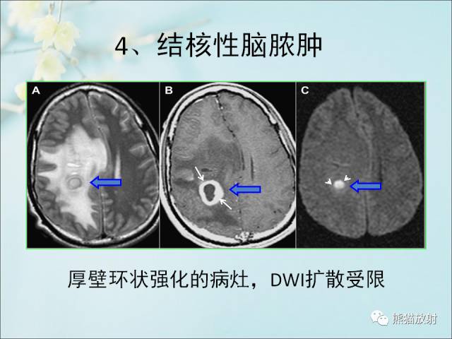 【PPT 】颅内结核专家共识解读