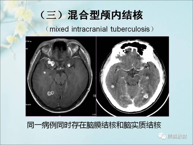 【PPT 】颅内结核专家共识解读