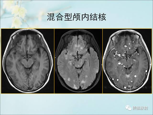 【PPT 】颅内结核专家共识解读